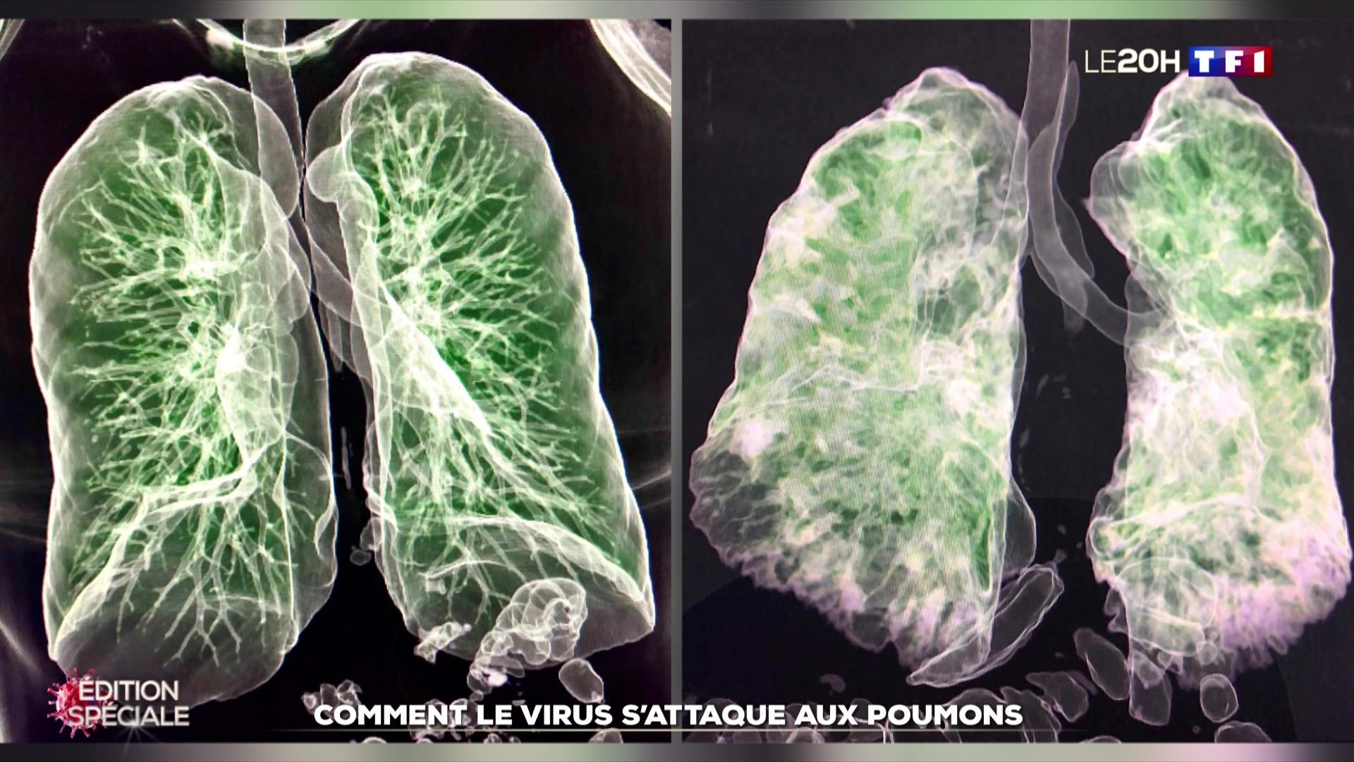 Les images 3D des dégâts du virus dans les poumons | LCI