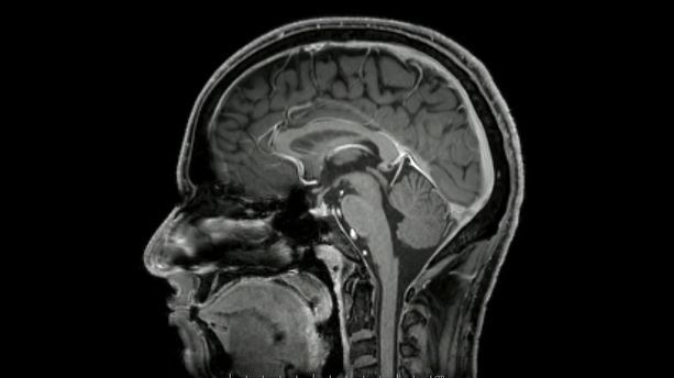 Le Covid-19 pourrait altérer la matière grise du cerveau même chez les cas bénins